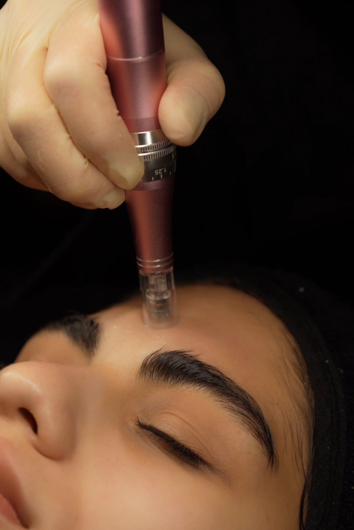MICRONEEDLING